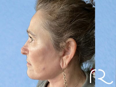 Extended Deep Neck Lift Before & After Gallery - Patient 404188 - Image 2