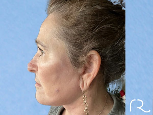 Extended Deep Neck Lift Before & After Gallery - Patient 404188 - Image 2
