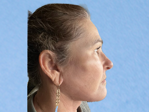R2 Extended Deep Neck Lift Before & After Gallery - Patient 404188 - Image 4