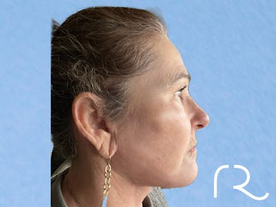 Extended Deep Neck Lift Before & After Gallery - Patient 404188 - Image 4