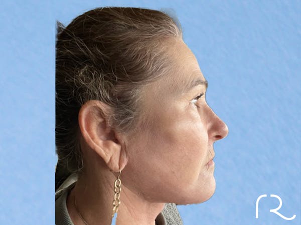 Facelift Before & After Gallery - Patient 401166 - Image 4