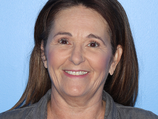 R2 Extended Deep Neck Lift Before & After Gallery - Patient 404188 - Image 5