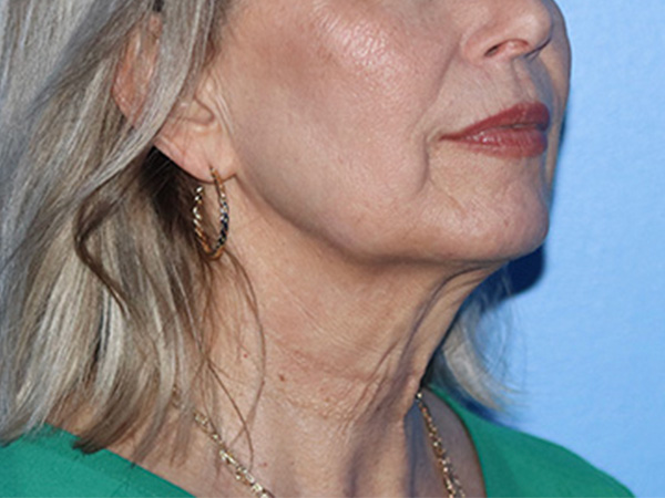 Neck Lift Before & After Gallery - Patient 168494163 - Image 1