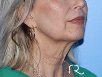 Neck Lift Before & After Gallery - Patient 168494163 - Image 1