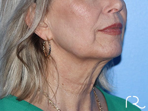 Neck Lift Before & After Gallery - Patient 168494163 - Image 1