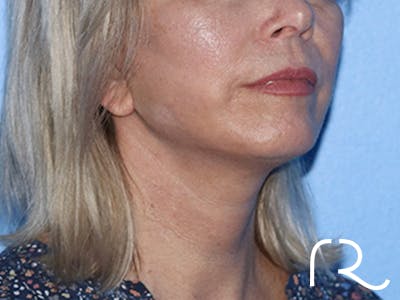 Neck Lift Before & After Gallery - Patient 168494163 - Image 2