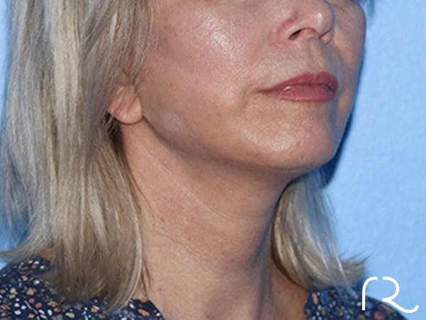 Neck Lift Before & After Gallery - Patient 168494163 - Image 2