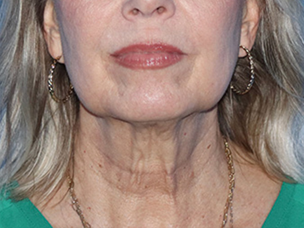 Neck Lift Before & After Gallery - Patient 168494163 - Image 3