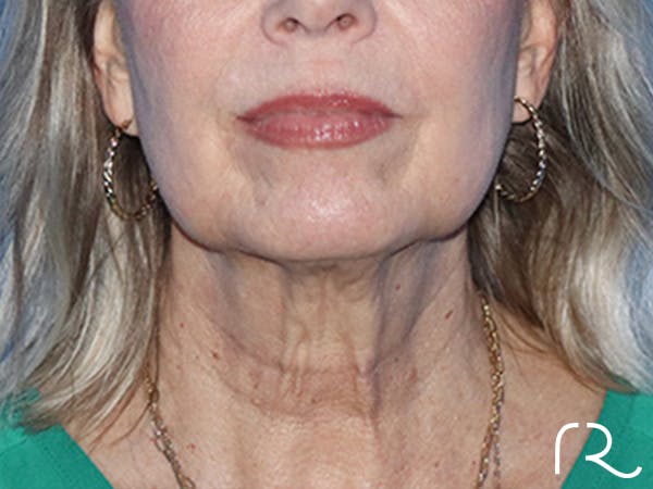 Facelift Before & After Gallery - Patient 168494161 - Image 3