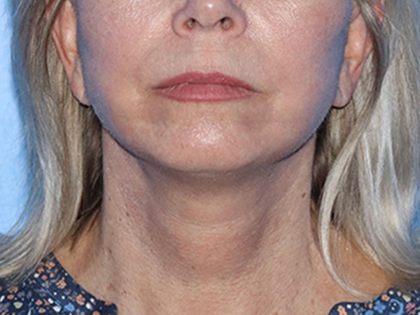 Neck Lift Before & After Gallery - Patient 168494163 - Image 4