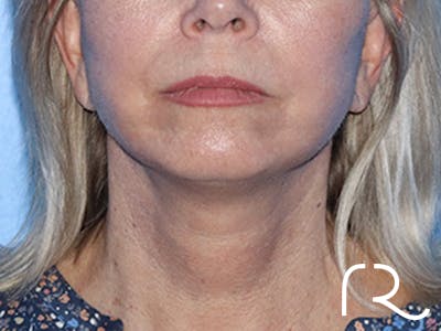 Neck Lift Before & After Gallery - Patient 168494163 - Image 4