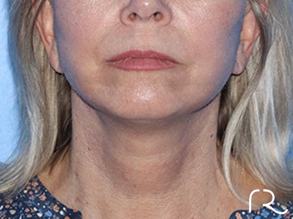 Facelift Before & After Gallery - Patient 168494161 - Image 4