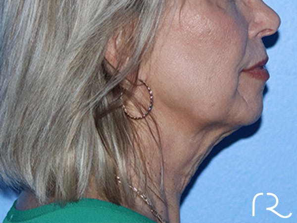 Facelift Before & After Gallery - Patient 168494161 - Image 5