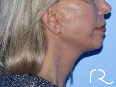 Neck Lift Before & After Gallery - Patient 168494163 - Image 6