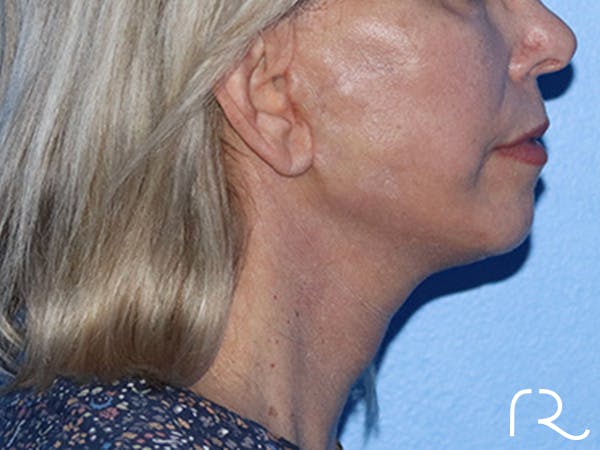 Neck Lift Before & After Gallery - Patient 168494163 - Image 6