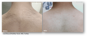 Laser Hair Removal with Clarity II