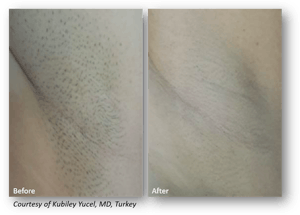 Laser Hair Removal with Clarity II