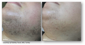 Laser Hair Removal with Clarity II