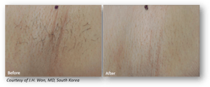 Laser Hair Removal with Clarity II