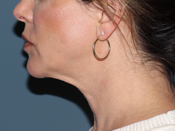 Neck Lift Before & After Gallery - Patient 266487 - Image 3