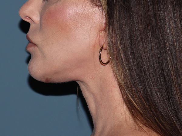 Neck Lift Before & After Gallery - Patient 266487 - Image 4