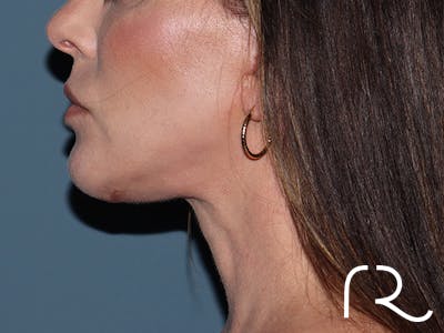Neck Lift Before & After Gallery - Patient 266487 - Image 4