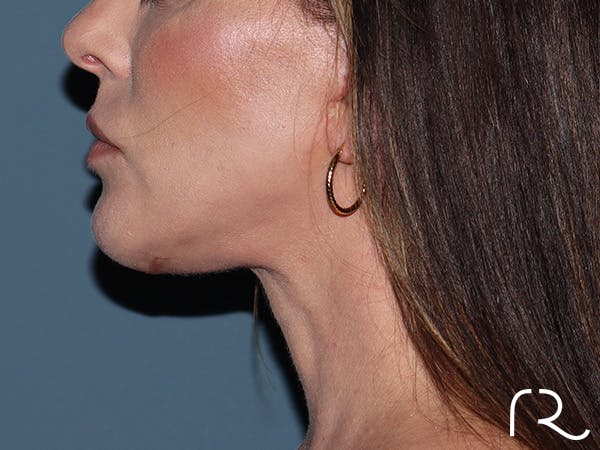 Neck Lift Before & After Gallery - Patient 266487 - Image 4