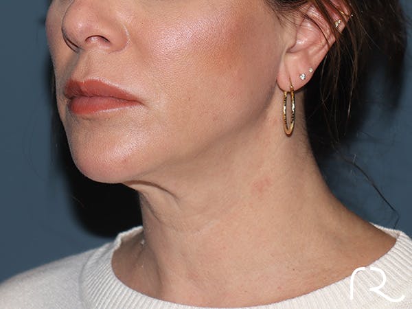 Neck Lift Before & After Gallery - Patient 266487 - Image 1