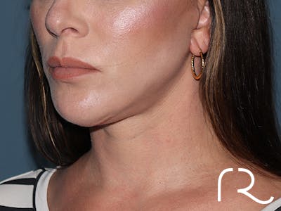 Neck Lift Before & After Gallery - Patient 266487 - Image 2