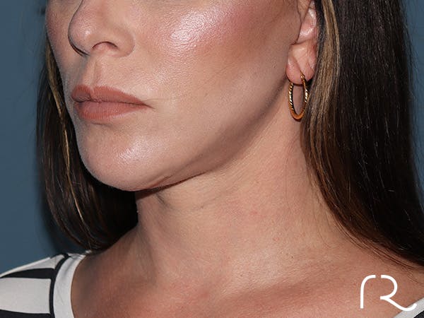 Neck Lift Before & After Gallery - Patient 266487 - Image 2