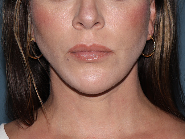 Neck Lift Before & After Gallery - Patient 266487 - Image 5