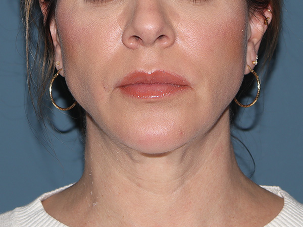 Neck Lift Before & After Gallery - Patient 266487 - Image 6