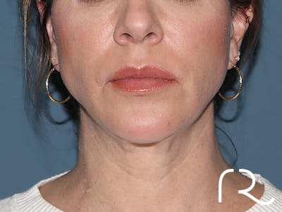 Neck Lift Before & After Gallery - Patient 266487 - Image 6