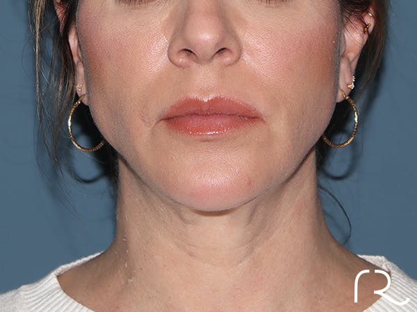 Neck Lift Before & After Gallery - Patient 266487 - Image 6