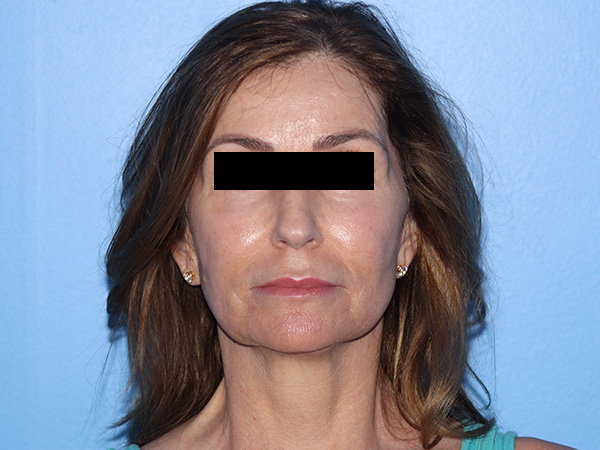 Fractional CO2 Laser Resurfacing Before & After Gallery - Patient 416933 - Image 1