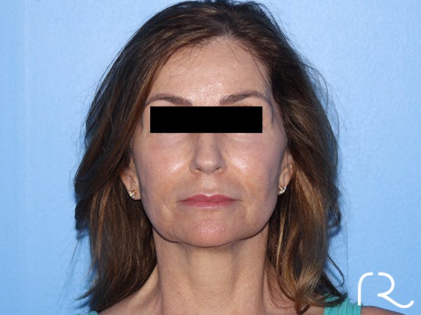 Fractional CO2 Laser Resurfacing Before & After Gallery - Patient 416933 - Image 1