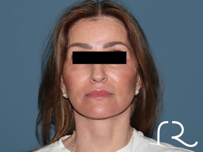 Fractional CO2 Laser Resurfacing Before & After Gallery - Patient 416933 - Image 2
