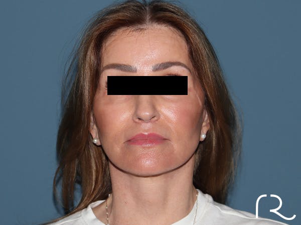 Fractional CO2 Laser Resurfacing Before & After Gallery - Patient 416933 - Image 2