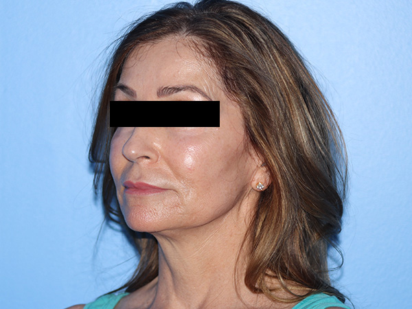 Facelift Before & After Gallery - Patient 788301 - Image 1