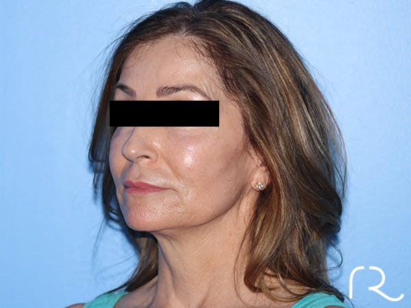 Fractional CO2 Laser Resurfacing Before & After Gallery - Patient 416933 - Image 3