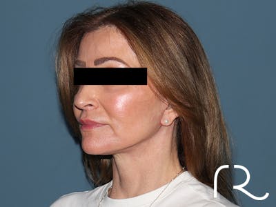 Fractional CO2 Laser Resurfacing Before & After Gallery - Patient 416933 - Image 4
