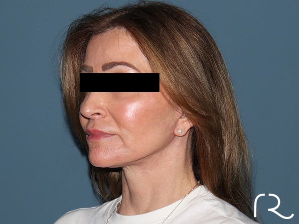 Fractional CO2 Laser Resurfacing Before & After Gallery - Patient 416933 - Image 4