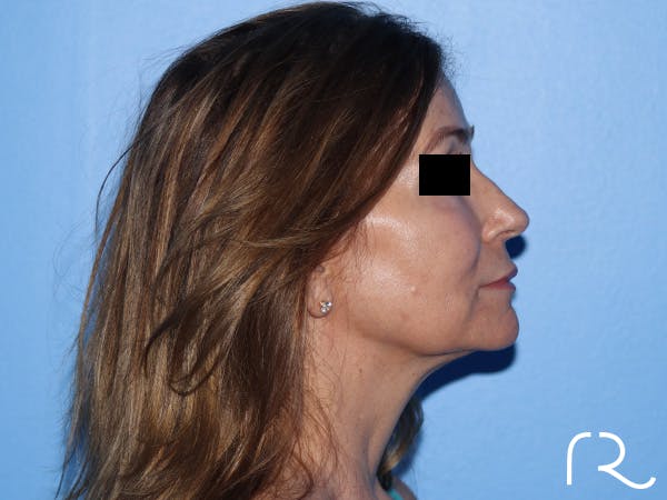 Fractional CO2 Laser Resurfacing Before & After Gallery - Patient 416933 - Image 5