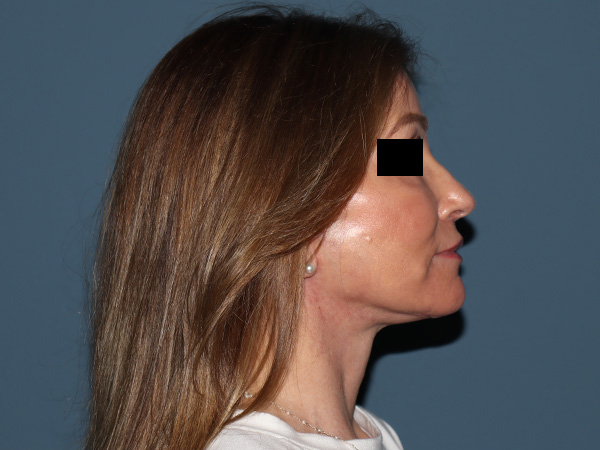 Fractional CO2 Laser Resurfacing Before & After Gallery - Patient 416933 - Image 6
