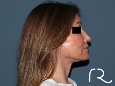 Fractional CO2 Laser Resurfacing Before & After Gallery - Patient 416933 - Image 6