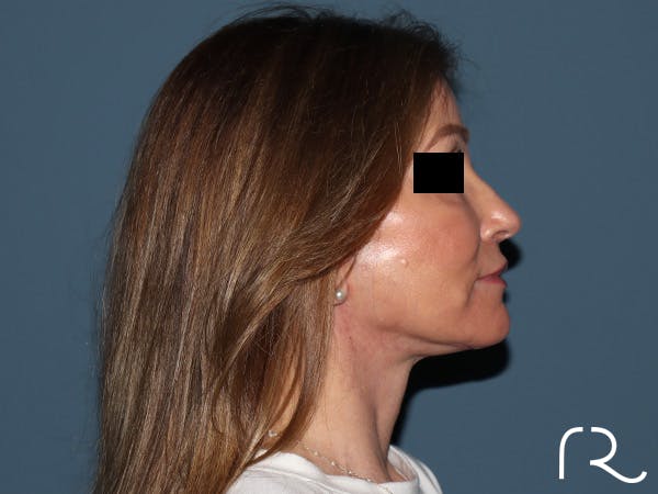 Fractional CO2 Laser Resurfacing Before & After Gallery - Patient 416933 - Image 6