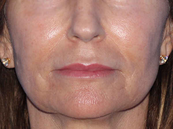 Lip Lift Before & After Gallery - Patient 422442 - Image 1