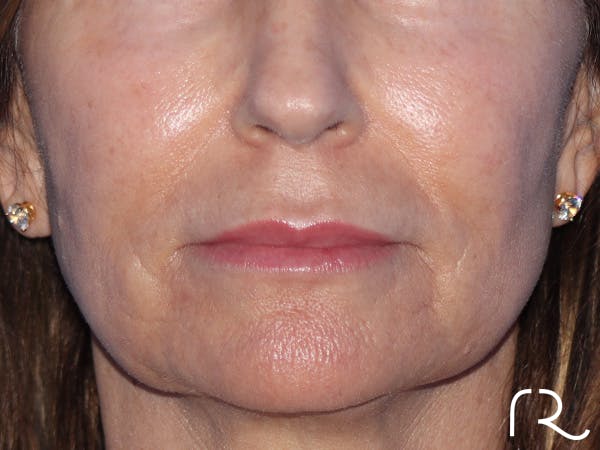 Lip Lift Before & After Gallery - Patient 422442 - Image 1