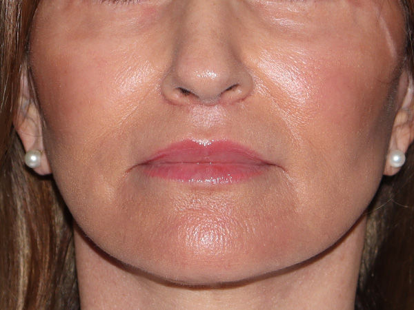 Lip Lift Before & After Gallery - Patient 422442 - Image 2