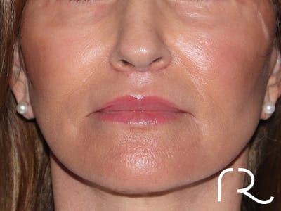 Lip Lift Before & After Gallery - Patient 422442 - Image 2